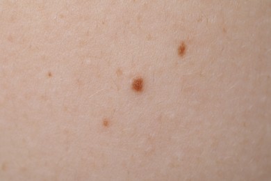 Photo of Woman with moles on her skin, macro view