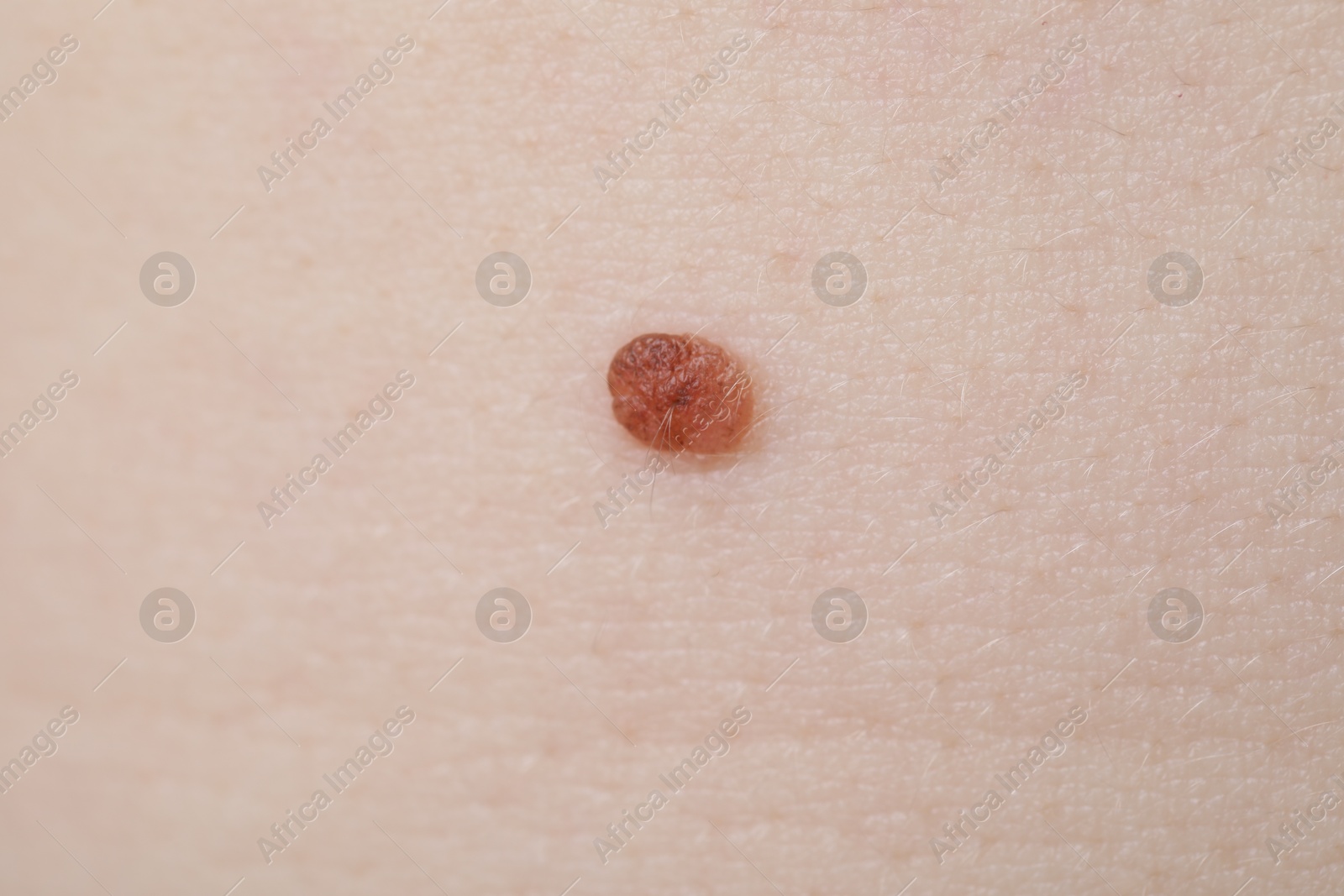 Woman with mole on her skin, macro view Photo of Woman with mole on her skin, macro view