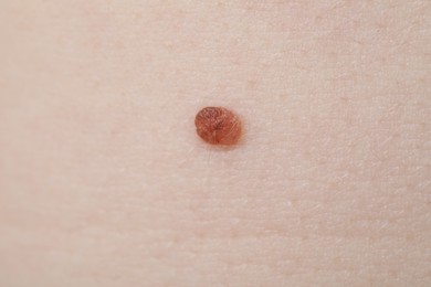 Photo of Woman with mole on her skin, macro view