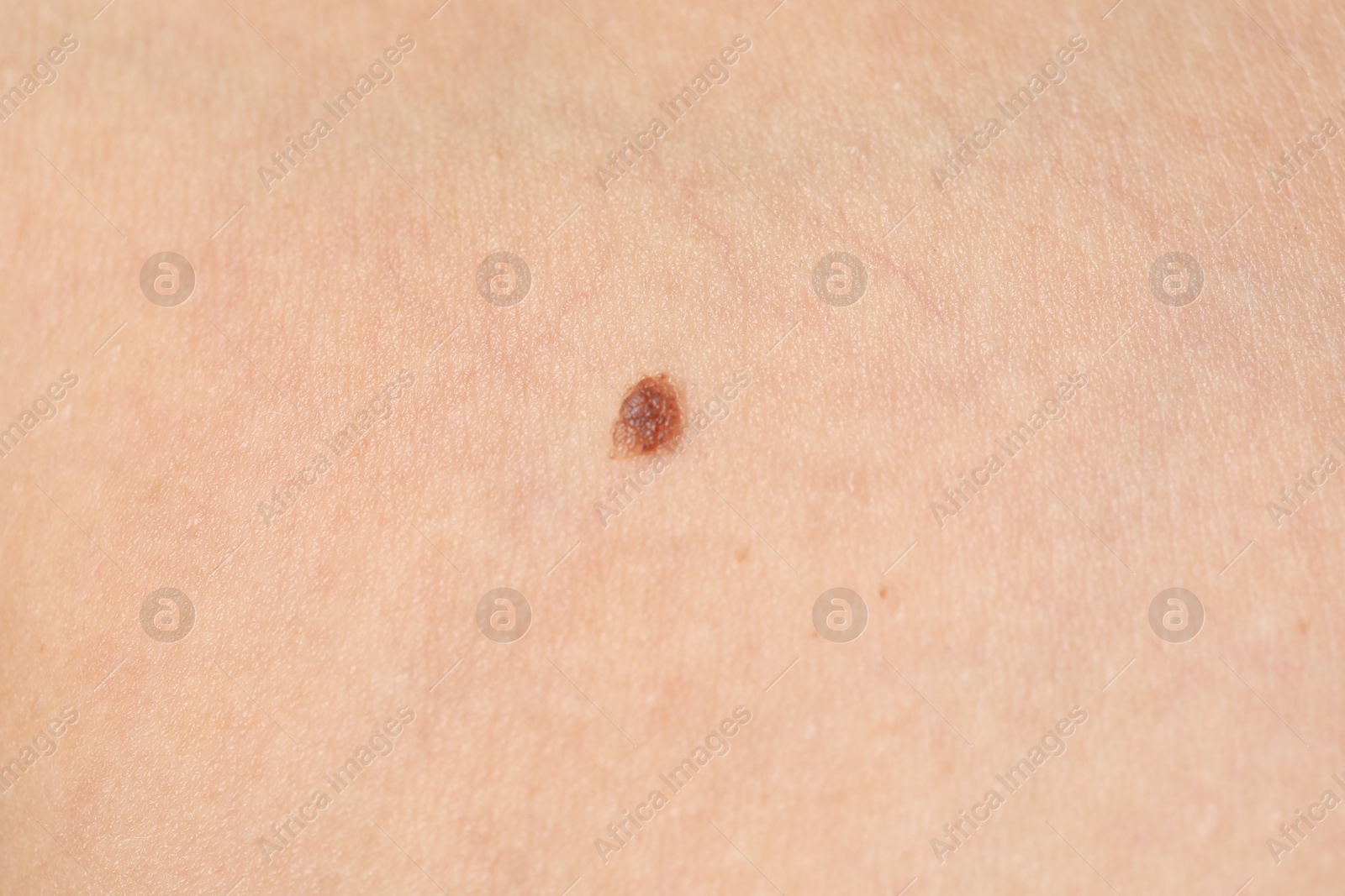 Woman with mole on her body, closeup Photo of Woman with mole on her body, closeup
