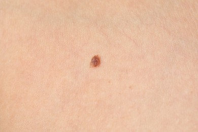 Photo of Woman with mole on her body, closeup