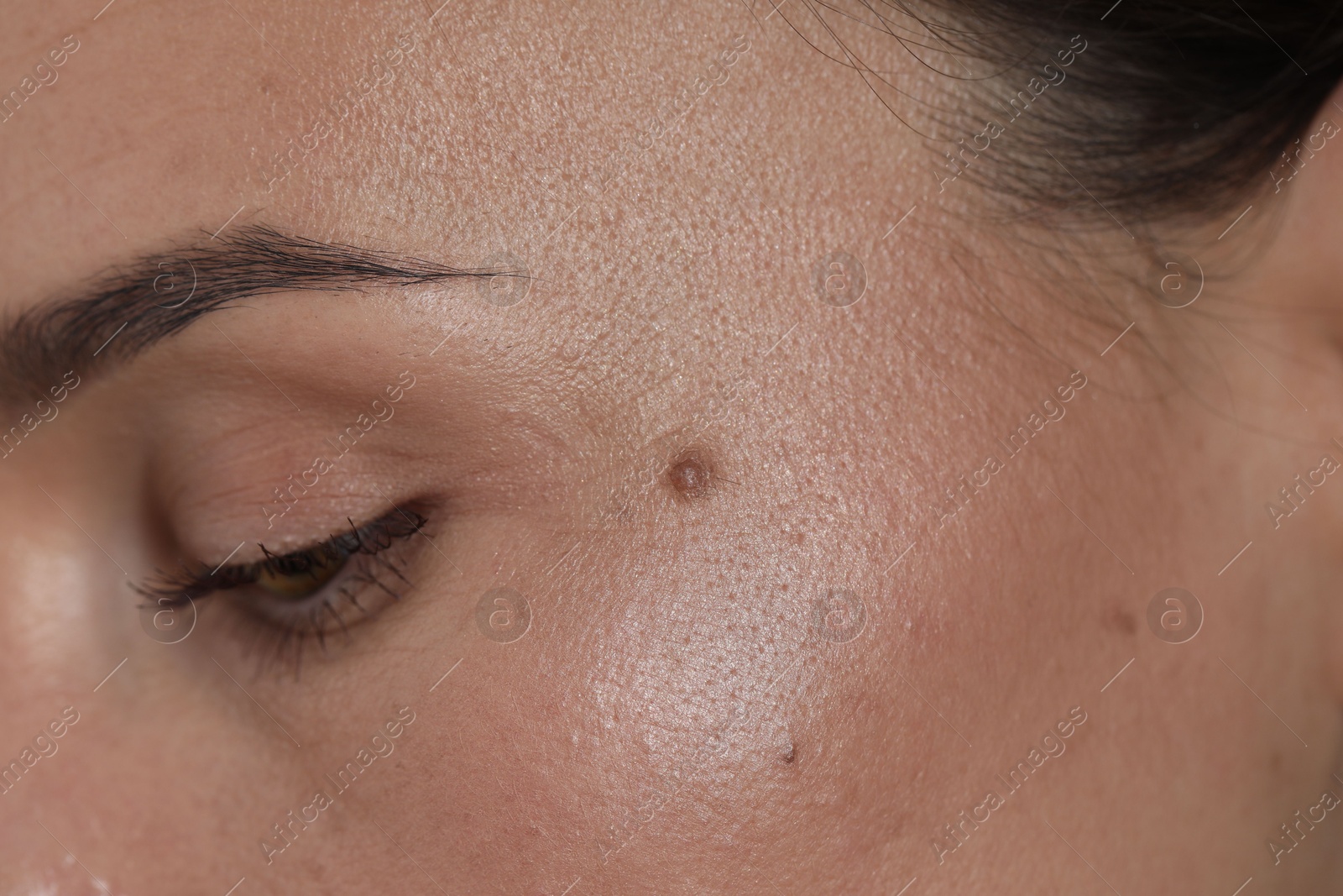 Woman with moles on her face, closeup Photo of Woman with moles on her face, closeup