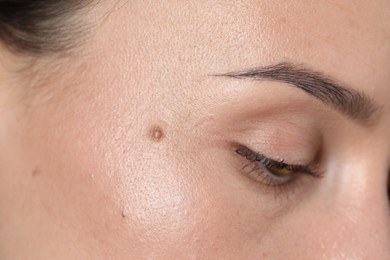 Photo of Woman with moles on her face, closeup