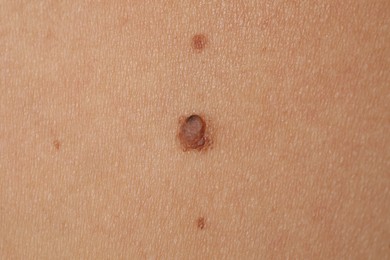 Photo of Woman with moles on her body, closeup