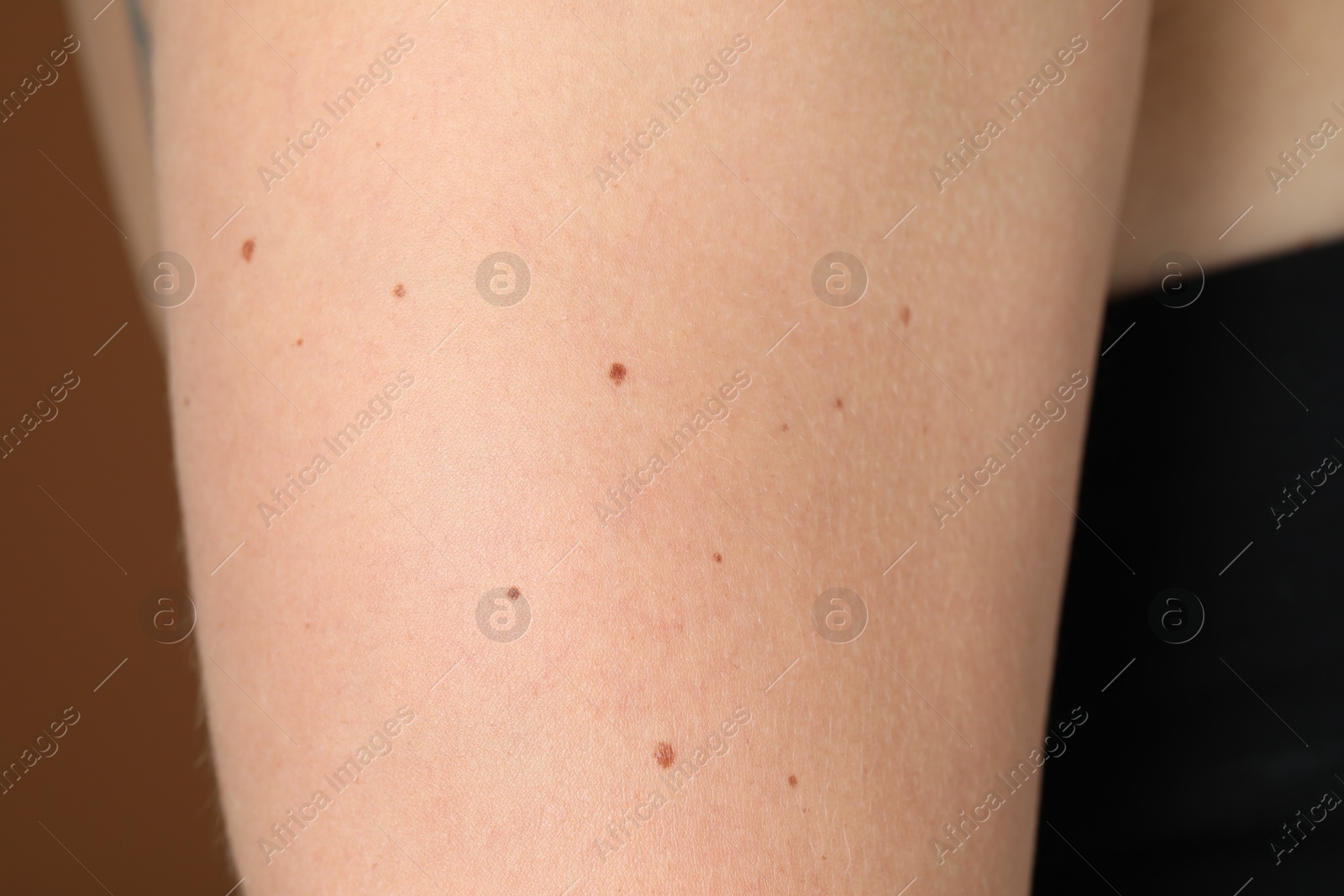 Photo of Woman with moles on her body against brown background, closeup