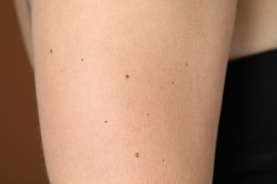 Photo of Woman with moles on her body against brown background, closeup
