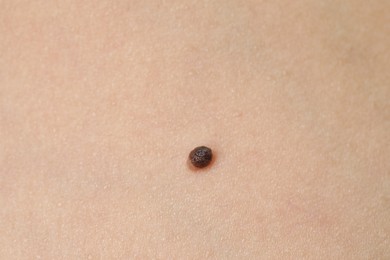 Photo of Woman with mole on her body, closeup