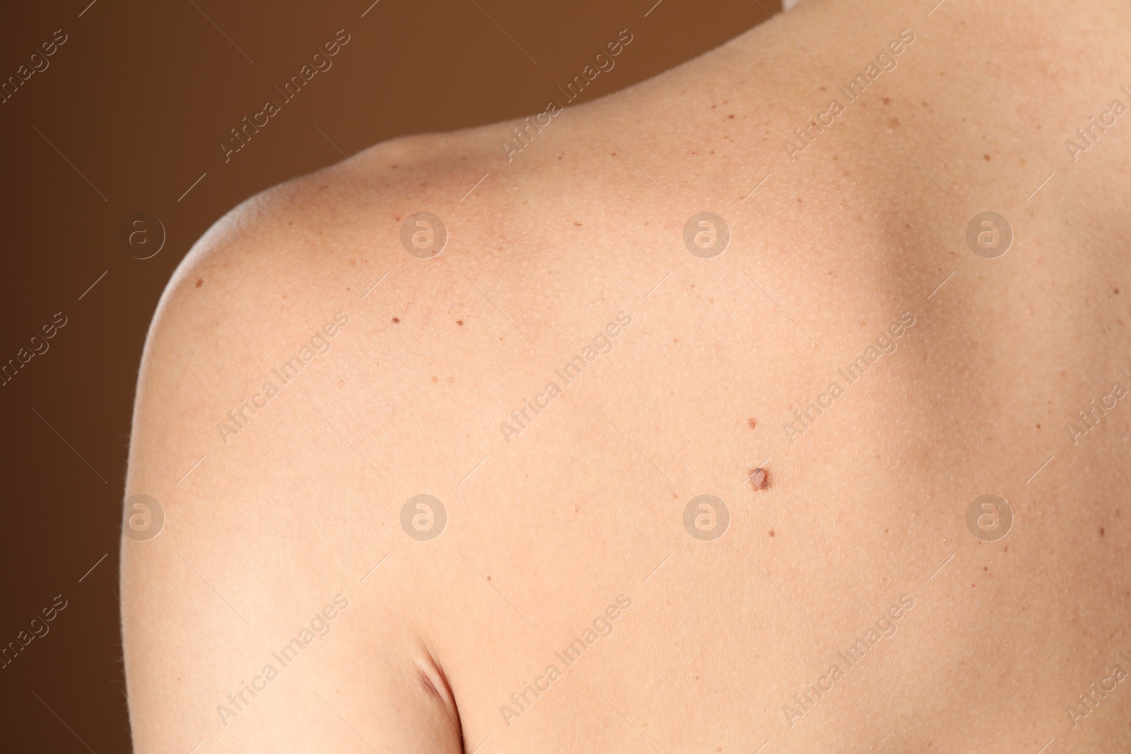 Photo of Woman with moles on her body against brown background, closeup