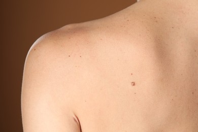 Photo of Woman with moles on her body against brown background, closeup