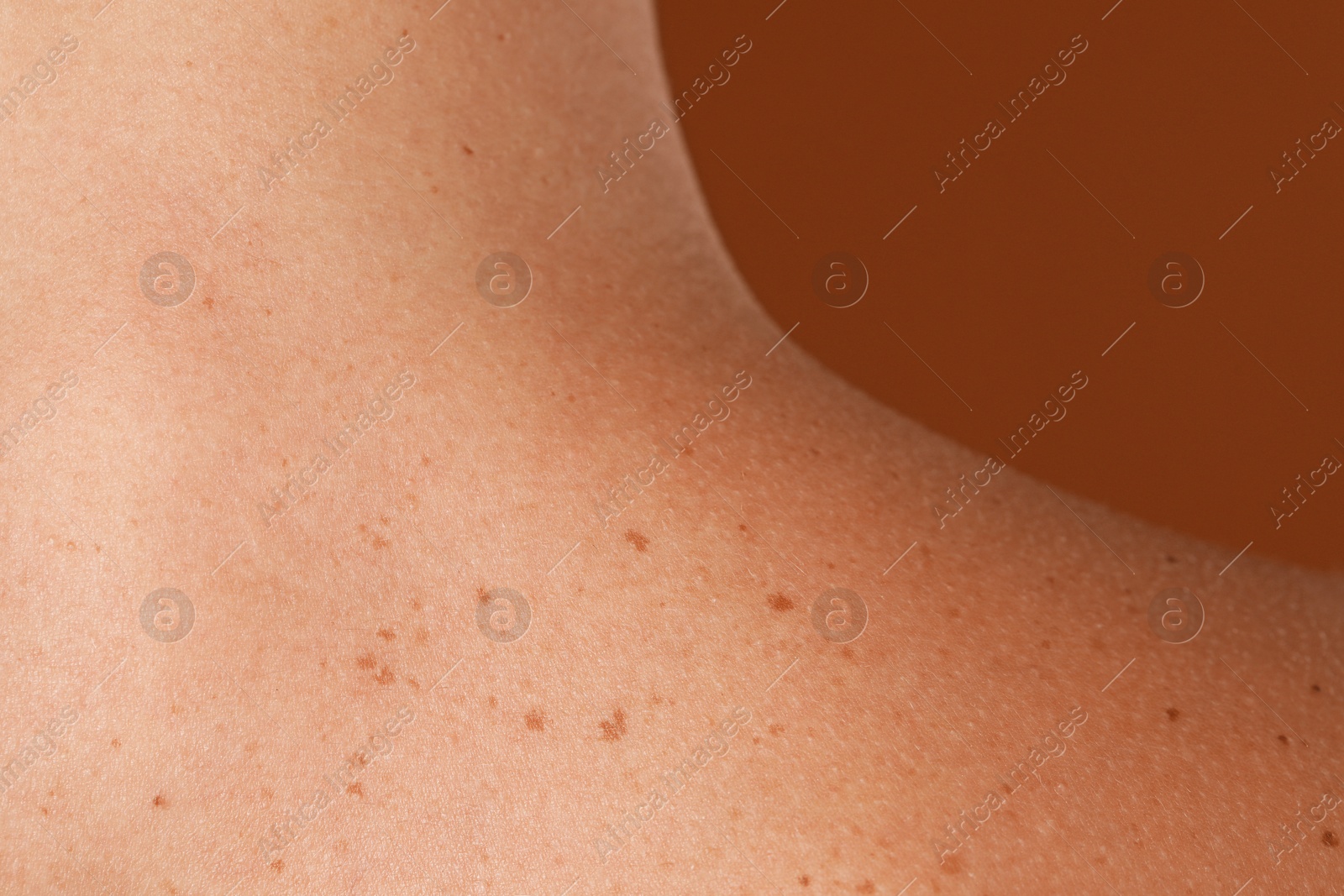 Woman with moles on her body against brown background, closeup Photo of Woman with moles on her body against brown background, closeup