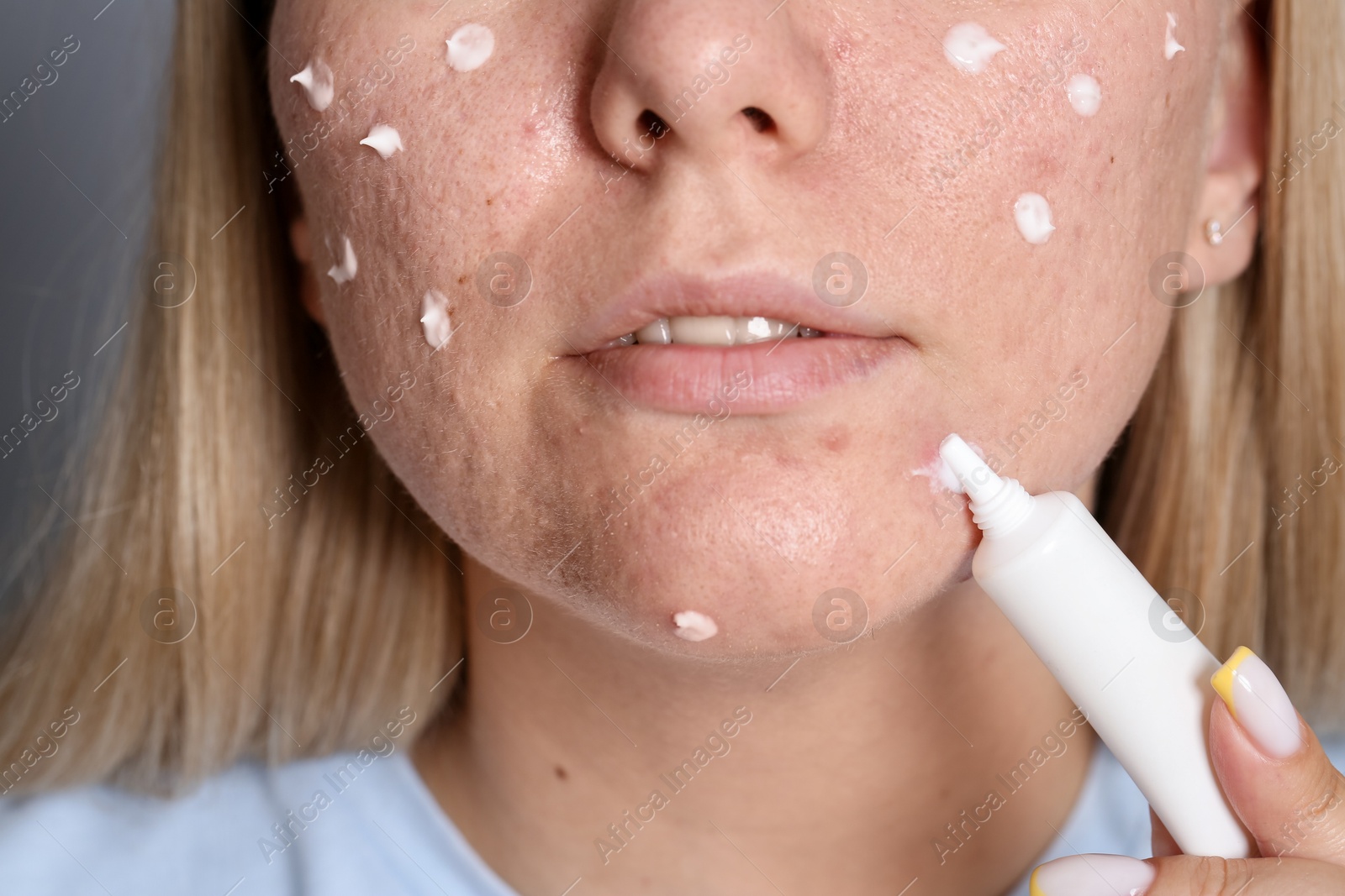 Photo of Woman applying cream onto face, closeup. Acne treatment