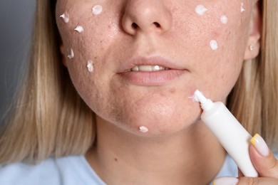 Photo of Woman applying cream onto face, closeup. Acne treatment