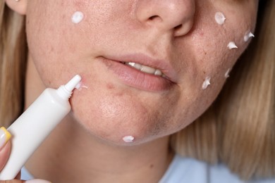 Photo of Woman applying cream onto face, closeup. Acne treatment