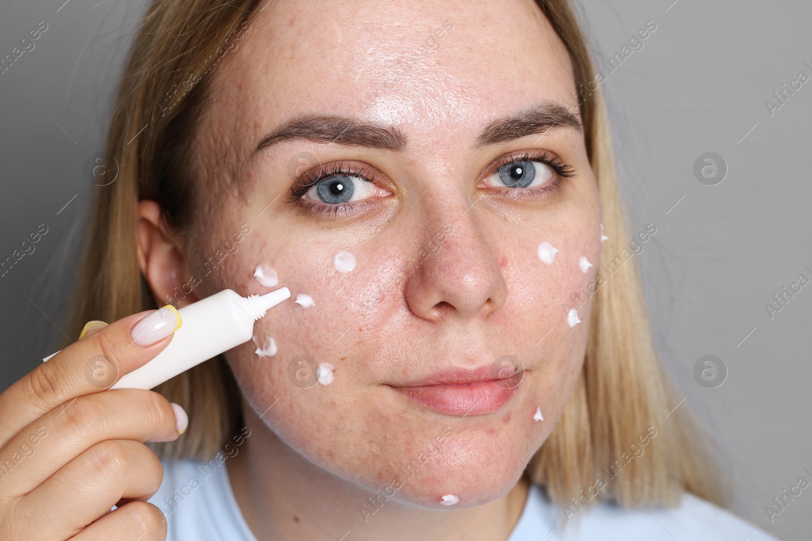 Woman applying cream onto face on grey background. Acne treatment Photo of Woman applying cream onto face on grey background. Acne treatment