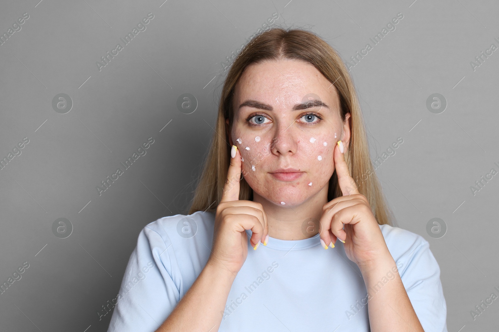Woman applying cream onto face on grey background. Acne treatment Photo of Woman applying cream onto face on grey background. Acne treatment