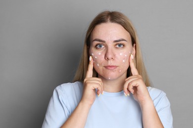 Photo of Woman applying cream onto face on grey background. Acne treatment