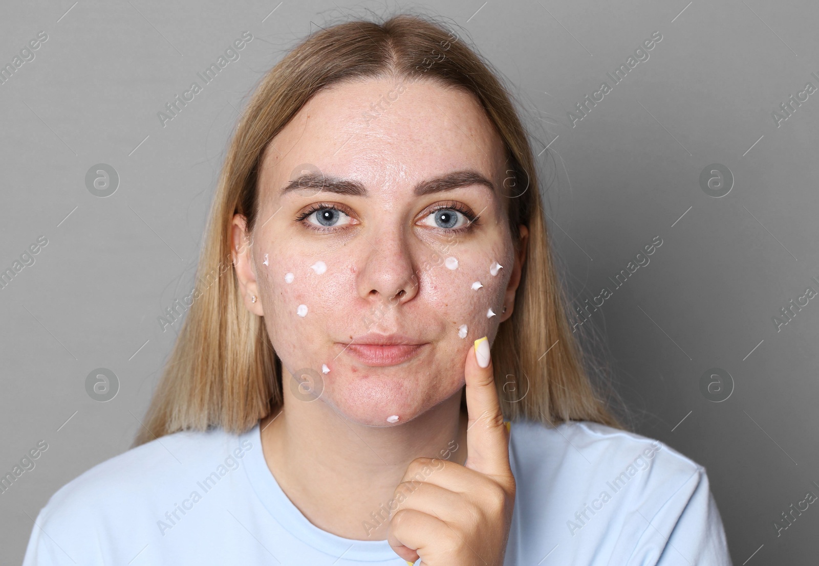Photo of Woman applying cream onto face on grey background. Acne treatment