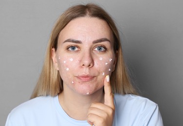 Photo of Woman applying cream onto face on grey background. Acne treatment
