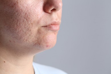 Photo of Woman with acne problem on grey background, closeup. Space for text