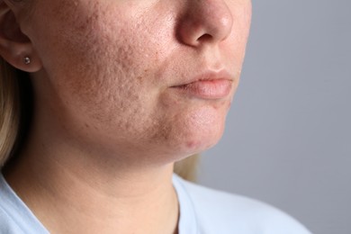 Photo of Woman with acne problem on grey background, closeup. Space for text