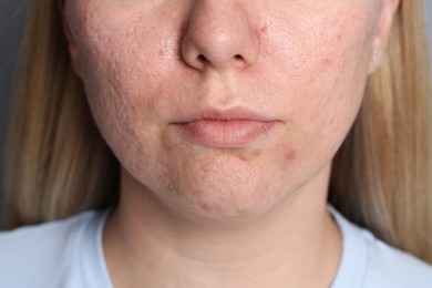 Photo of Closeup view of woman with acne problem