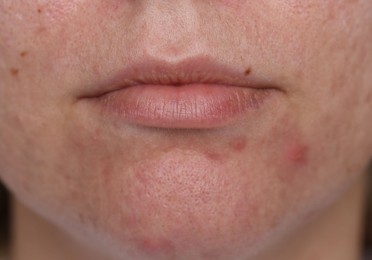 Photo of Closeup view of woman with acne problem