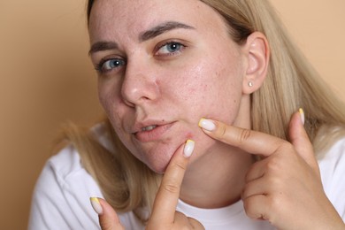 Photo of Woman with acne problem on beige background