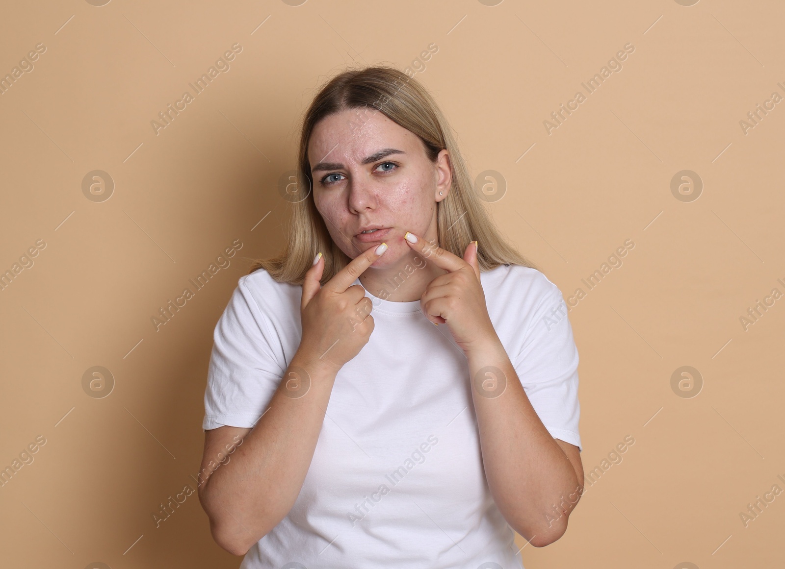 Woman with acne problem on beige background Photo of Woman with acne problem on beige background
