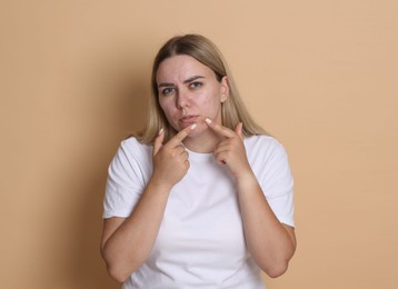 Photo of Woman with acne problem on beige background