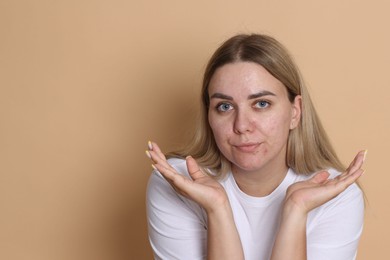Photo of Woman with acne problem on beige background, space for text