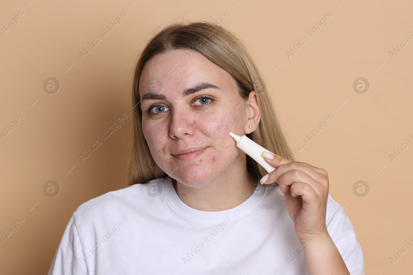 Woman applying cream onto face on beige background. Acne treatment Photo of Woman applying cream onto face on beige background. Acne treatment