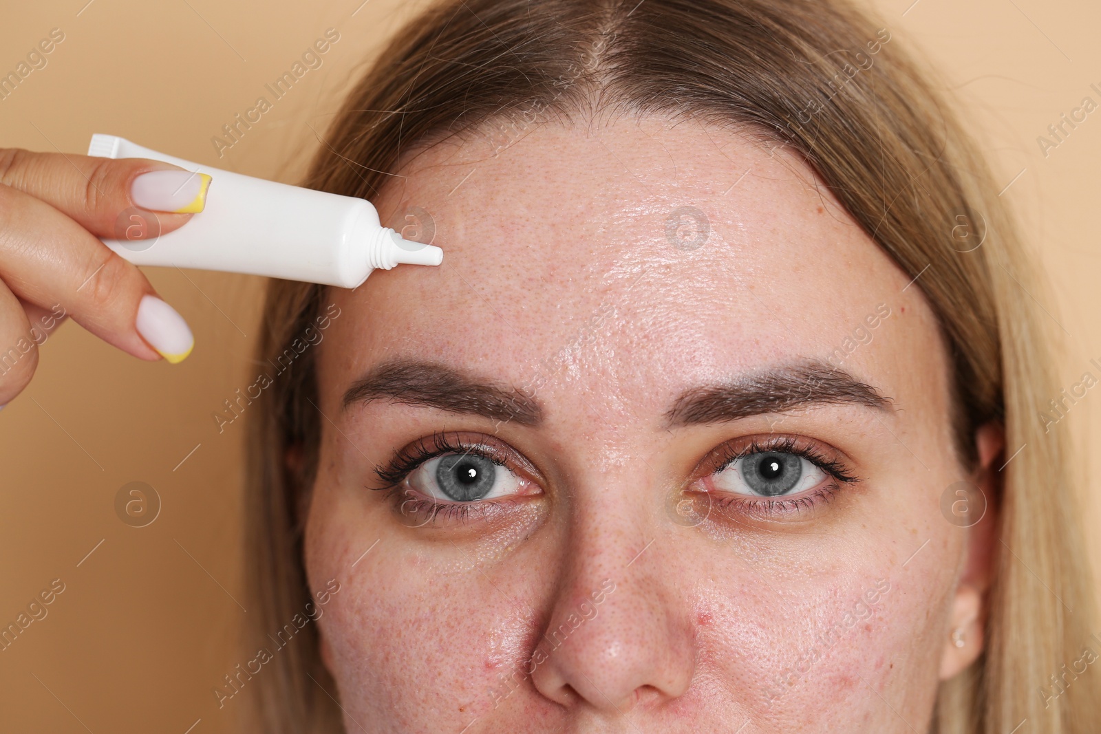 Woman applying cream onto face on beige background, closeup. Acne treatment Photo of Woman applying cream onto face on beige background, closeup. Acne treatment