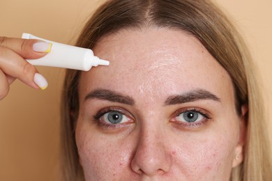 Photo of Woman applying cream onto face on beige background, closeup. Acne treatment