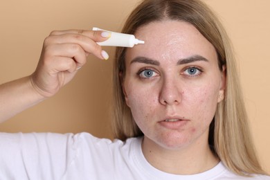 Photo of Woman applying cream onto face on beige background. Acne treatment
