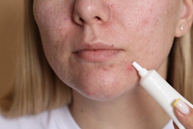 Photo of Woman applying cream onto face on beige background, closeup. Acne treatment