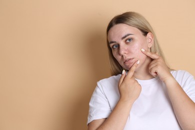 Photo of Woman with acne problem on beige background, space for text