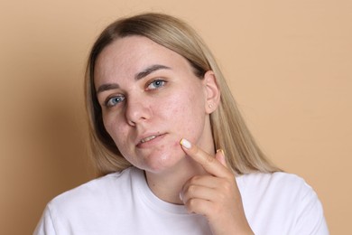 Photo of Woman with acne problem on beige background