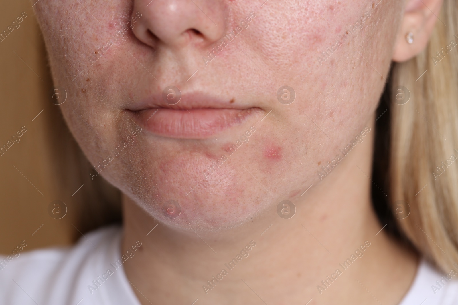 Woman with acne problem on beige background, closeup Photo of Woman with acne problem on beige background, closeup