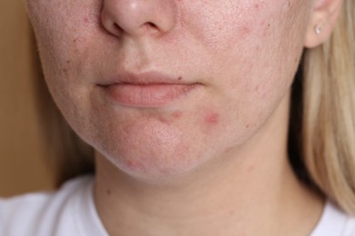 Photo of Woman with acne problem on beige background, closeup