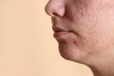 Photo of Woman with acne problem on beige background, closeup. Space for text