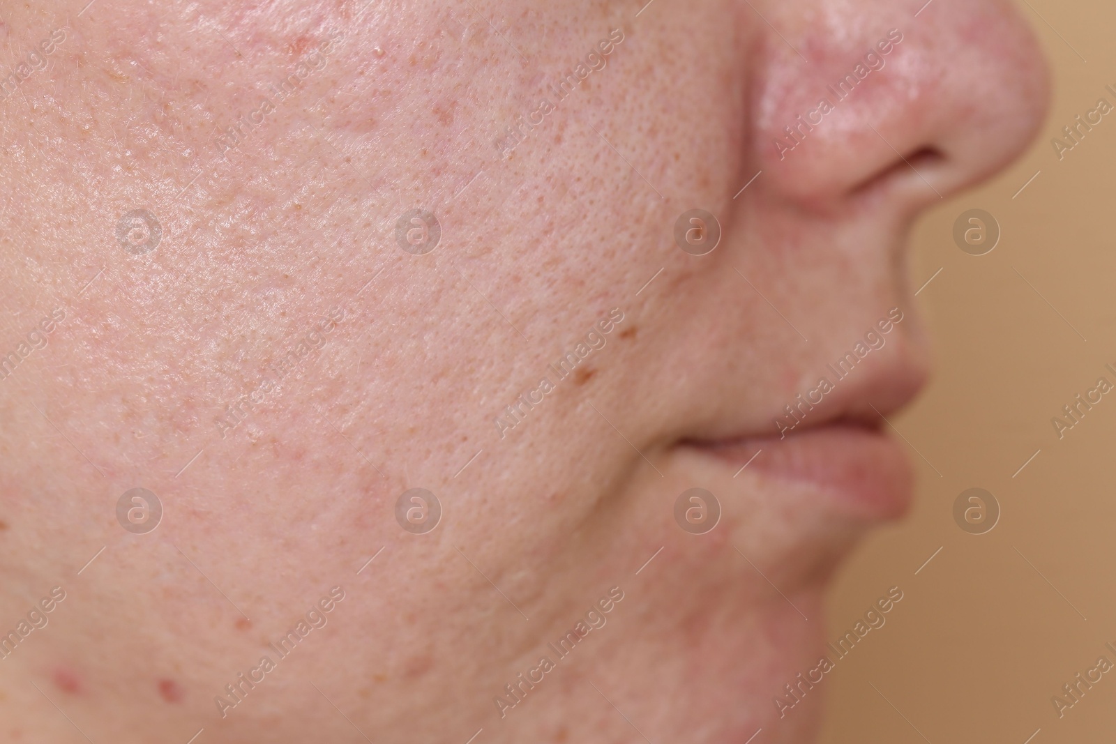 Woman with acne problem on beige background, closeup Photo of Woman with acne problem on beige background, closeup
