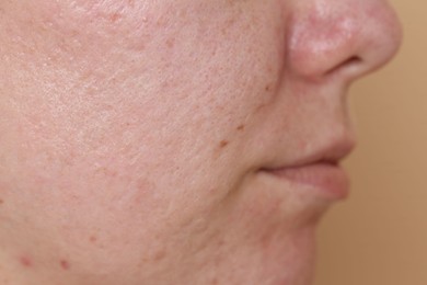 Photo of Woman with acne problem on beige background, closeup