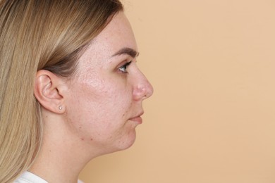 Photo of Woman with acne problem on beige background, space for text