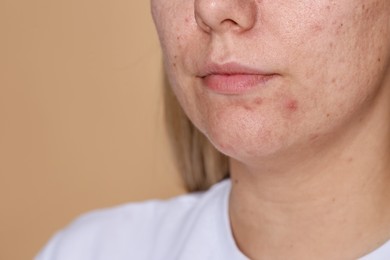 Photo of Woman with acne problem on beige background, closeup. Space for text