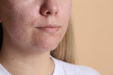 Photo of Woman with acne problem on beige background, closeup. Space for text