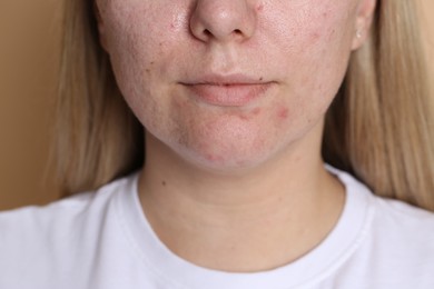 Photo of Woman with acne problem on beige background, closeup