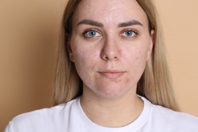 Photo of Woman with acne problem on beige background
