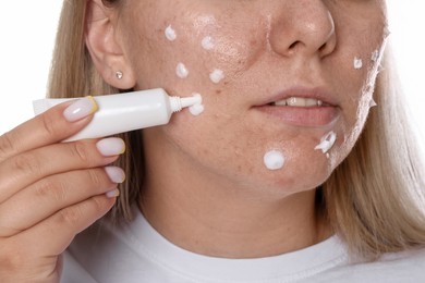 Photo of Woman applying cream onto face on white background, closeup. Acne treatment