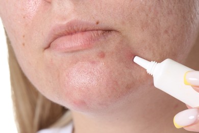 Photo of Woman applying cream onto face, closeup. Acne treatment