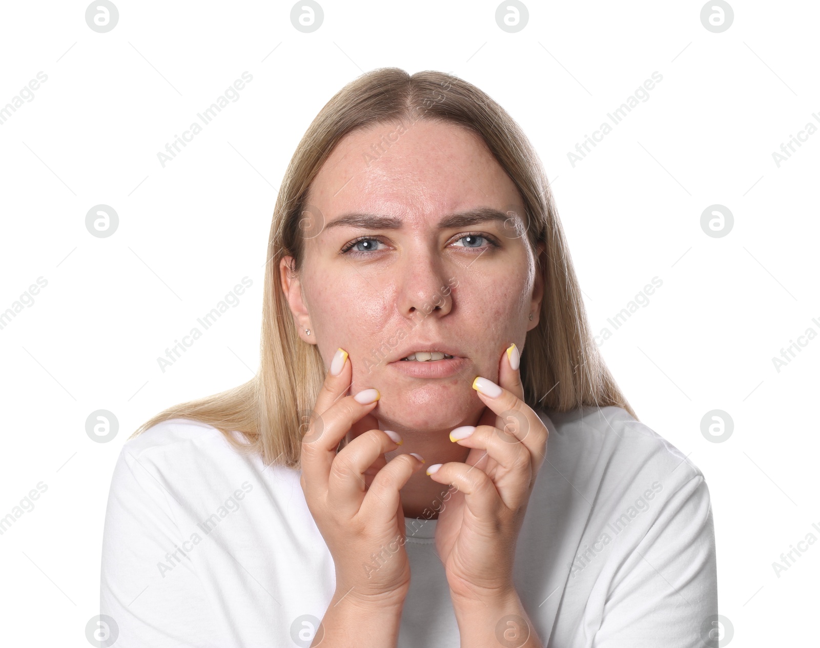 Woman with acne problem on white background Photo of Woman with acne problem on white background